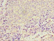 I-BABP / FABP6 Antibody - Immunohistochemistry of paraffin-embedded human rectal cancer using antibody at 1:100 dilution.