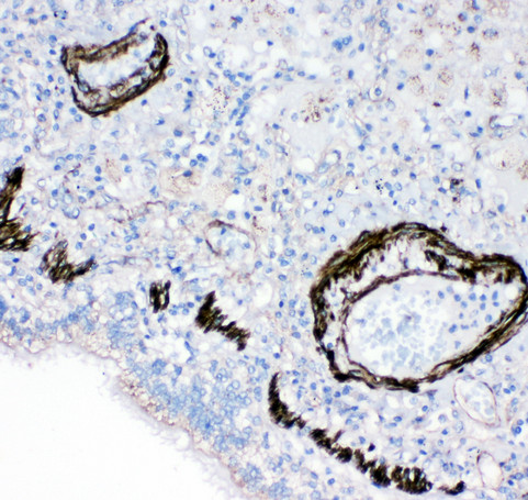 I-BABP / FABP6 Antibody - I-BABP / FABP6 antibody. IHC(P): Human Lung Cancer Tissue.