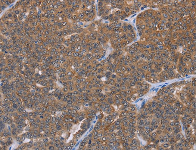 I-BABP / FABP6 Antibody - Immunohistochemistry of paraffin-embedded Human ovarian cancer using FABP6 Polyclonal Antibody at dilution of 1:30.