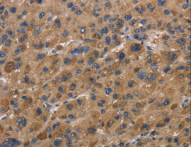 I-FABP / FABP2 Antibody - Immunohistochemistry of paraffin-embedded Human liver cancer using FABP2 Polyclonal Antibody at dilution of 1:40.