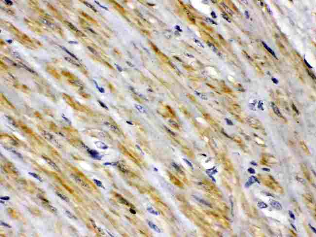 I-FABP / FABP2 Antibody - FABP2/I-FABP was detected in paraffin-embedded sections of human intestinal cancer tissues using rabbit anti- FABP2/I-FABP Antigen Affinity purified polyclonal antibody