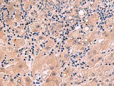 IA-6 / INSM2 Antibody - Immunohistochemistry of paraffin-embedded Human liver cancer tissue  using INSM2 Polyclonal Antibody at dilution of 1:35(×200)