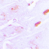 IAPP / Amylin Antibody - Immunohistochemical analysis of Amylin staining in human brain formalin fixed paraffin embedded tissue section. The section was pre-treated using heat mediated antigen retrieval with sodium citrate buffer (pH 6.0). The section was then incubated with the antibody at room temperature and detected using an HRP conjugated compact polymer system. DAB was used as the chromogen. The section was then counterstained with hematoxylin and mounted with DPX.