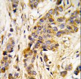 IARS2 Antibody - Formalin-fixed and paraffin-embedded human breast carcinoma tissue reacted with IARS2 antibody , which was peroxidase-conjugated to the secondary antibody, followed by DAB staining. This data demonstrates the use of this antibody for immunohistochemistry; clinical relevance has not been evaluated.