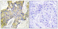 IARS2 Antibody - Peptide - + Immunohistochemistry analysis of paraffin-embedded human breast carcinoma tissue using IARS2 antibody.