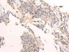 IBA57 / C1orf69 Antibody - Immunohistochemistry of paraffin-embedded Human ovarian cancer tissue  using IBA57 Polyclonal Antibody at dilution of 1:65(×200)