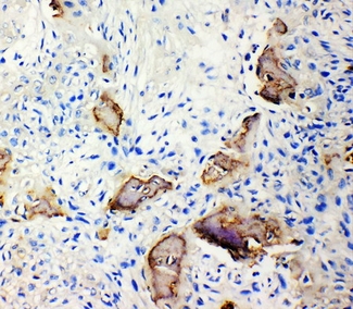 IBSP / Bone Sialoprotein Antibody - Anti-Bone Sialoprotein antibody, IHC(P): Human Osteosarcoma Tissue