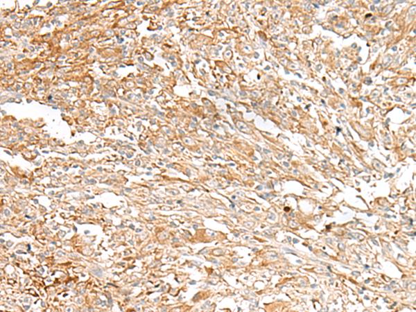 IBSP / Bone Sialoprotein Antibody - Immunohistochemistry of paraffin-embedded Human liver cancer tissue  using IBSP Polyclonal Antibody at dilution of 1:30(×200)