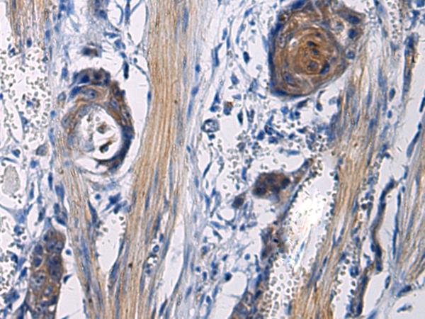 ICA69 / ICA1 Antibody - Immunohistochemistry of paraffin-embedded Human esophagus cancer tissue  using ICA1 Polyclonal Antibody at dilution of 1:50(×200)