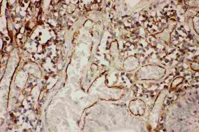 ICAM-1 / CD54 Antibody - Anti-ICAM1 Picoband antibody, IHC(P): Human Intestinal Cancer Tissue