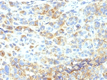 ICAM-1 / CD54 Antibody - Formalin-fixed, paraffin-embedded human melanoma stained with ICAM-1 antibody (1H4).  This image was taken for the unmodified form of this product. Other forms have not been tested.