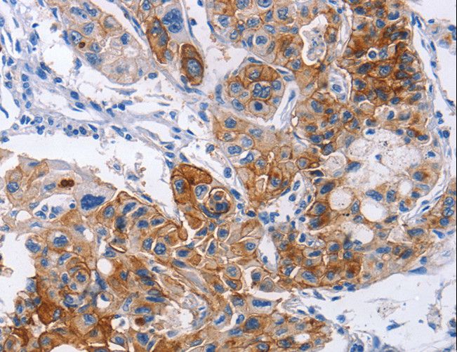 ICAM-1 / CD54 Antibody - Immunohistochemistry of paraffin-embedded Human lung cancer using ICAM1 Polyclonal Antibody at dilution of 1:30.
