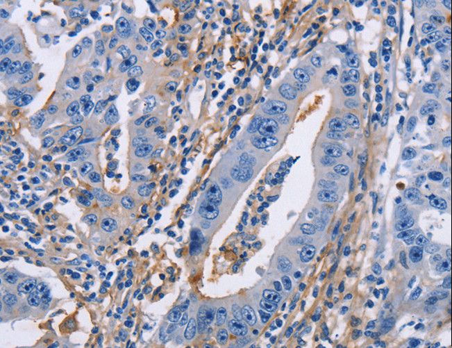 ICAM-1 / CD54 Antibody - Immunohistochemistry of paraffin-embedded Human gastric cancer using ICAM1 Polyclonal Antibody at dilution of 1:30.