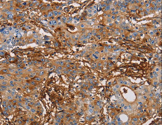 ICAM-1 / CD54 Antibody - Immunohistochemistry of paraffin-embedded Human gastric cancer using ICAM1 Polyclonal Antibody at dilution of 1:50.