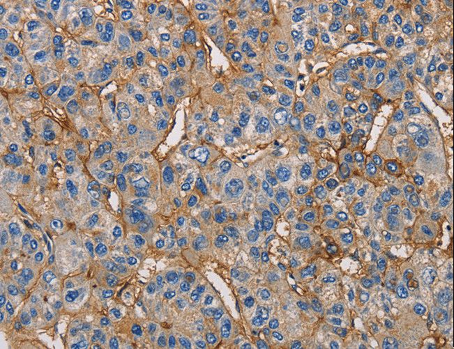 ICAM-1 / CD54 Antibody - Immunohistochemistry of paraffin-embedded Human liver cancer using ICAM1 Polyclonal Antibody at dilution of 1:50.