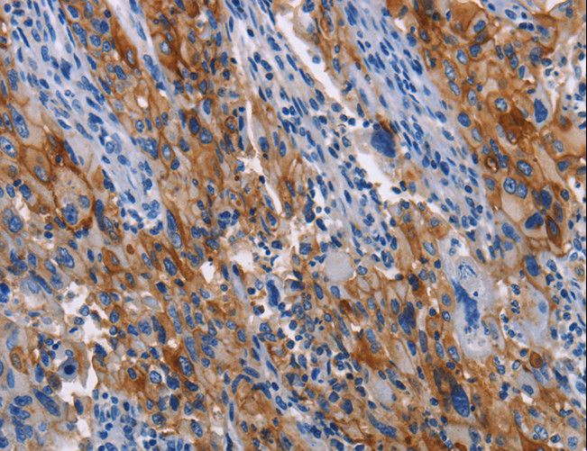 ICAM-1 / CD54 Antibody - Immunohistochemistry of paraffin-embedded Human lung cancer using ICAM1 Polyclonal Antibody at dilution of 1:40.