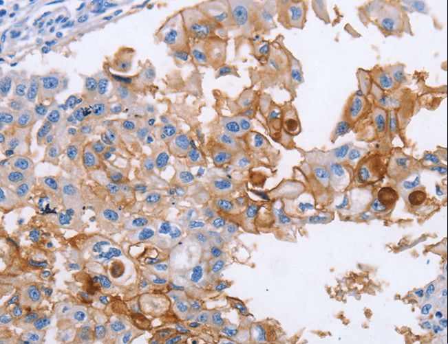 ICAM-1 / CD54 Antibody - Immunohistochemistry of paraffin-embedded Human breast cancer using ICAM1 Polyclonal Antibody at dilution of 1:40.