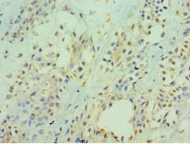 ICAM2 / CD102 Antibody - Immunohistochemistry of paraffin-embedded human breast cancer using antibody at 1:100 dilution.