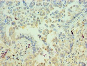 ICAM2 / CD102 Antibody - Immunohistochemistry of paraffin-embedded lung cancer prostate using antibody at 1:100 dilution.