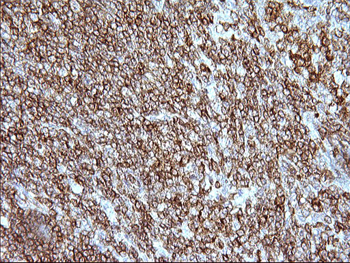 ICAM3 / CD50 Antibody - IHC of paraffin-embedded Human lymphoma tissue using anti-ICAM3 mouse monoclonal antibody. (Heat-induced epitope retrieval by 1 mM EDTA in 10mM Tris, pH8.5, 120°C for 3min).