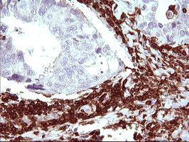 ICAM3 / CD50 Antibody - IHC of paraffin-embedded Adenocarcinoma of Human breast tissue using anti-ICAM3 mouse monoclonal antibody. (Heat-induced epitope retrieval by 10mM citric buffer, pH6.0, 120°C for 3min).