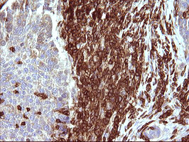 ICAM3 / CD50 Antibody - IHC of paraffin-embedded Carcinoma of Human lung tissue using anti-ICAM3 mouse monoclonal antibody. (Heat-induced epitope retrieval by 10mM citric buffer, pH6.0, 120°C for 3min).