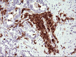 ICAM3 / CD50 Antibody - IHC of paraffin-embedded Carcinoma of Human prostate tissue using anti-ICAM3 mouse monoclonal antibody. (Heat-induced epitope retrieval by 10mM citric buffer, pH6.0, 120°C for 3min).