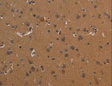 ICAM4 / CD242 Antibody - Immunohistochemistry of paraffin-embedded Human liver cancer using ICAM4 Polyclonal Antibody at dilution of 1:30.