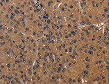 ICAM4 / CD242 Antibody - Immunohistochemistry of paraffin-embedded Human liver cancer using ICAM4 Polyclonal Antibody at dilution of 1:50.