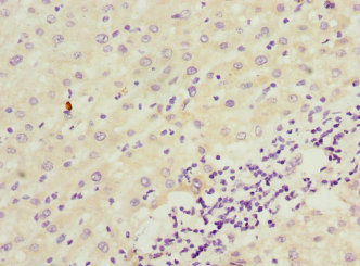 ICAM4 / CD242 Antibody - Immunohistochemistry of paraffin-embedded human liver cancer at dilution 1:100