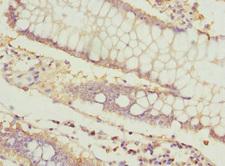 ICAM4 / CD242 Antibody - Immunohistochemistry of paraffin-embedded human colon cancer at dilution 1:100