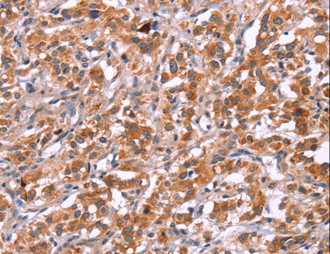 ICAM5 / ICAM-5 Antibody - Immunohistochemistry of paraffin-embedded Human thyroid cancer using ICAM5 Polyclonal Antibody at dilution of 1:25.