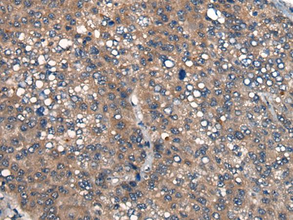 ICMT / PPMT Antibody - Immunohistochemistry of paraffin-embedded Human liver cancer tissue  using ICMT Polyclonal Antibody at dilution of 1:45(×200)