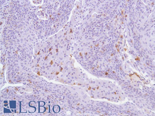 ICOS / CD278 Antibody - Immunohistochemistry of Human Cervical Squamous Cell Carcinoma stained with anti-CD278/ICOS antibody