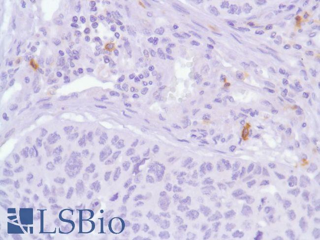 ICOS / CD278 Antibody - Immunohistochemistry of Human Lung Squamous Cell Carcinoma stained with anti-CD278/ICOS antibody