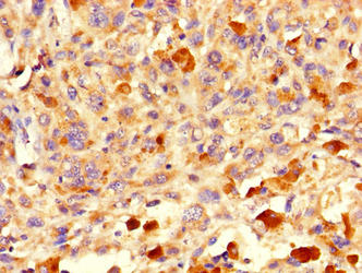 ICT1 / DS1 Antibody - Immunohistochemistry of paraffin-embedded human melanoma using MRPL58 Antibody at dilution of 1:100