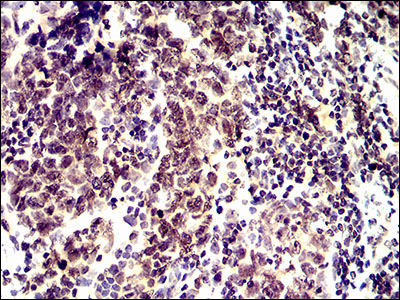 ID2 Antibody - IHC of paraffin-embedded breast cancer tissues using ID2 mouse monoclonal antibody with DAB staining.