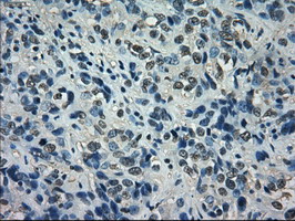 ID2 Antibody - IHC of paraffin-embedded Carcinoma of Human bladder tissue using anti-ID2 mouse monoclonal antibody.