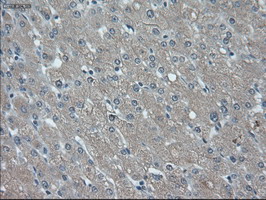 ID2 Antibody - IHC of paraffin-embedded Carcinoma of liver using anti-ID2 mouse monoclonal antibody.