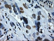 ID2 Antibody - IHC of paraffin-embedded Carcinoma of Human liver tissue using anti-ID2 mouse monoclonal antibody.