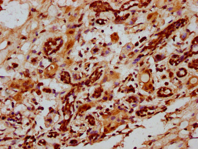 ID2 Antibody - IHC image of ID2 Antibody diluted at 1:1000 and staining in paraffin-embedded human breast cancer performed on a Leica BondTM system. After dewaxing and hydration, antigen retrieval was mediated by high pressure in a citrate buffer (pH 6.0). Section was blocked with 10% normal goat serum 30min at RT. Then primary antibody (1% BSA) was incubated at 4°C overnight. The primary is detected by a biotinylated secondary antibody and visualized using an HRP conjugated SP system.