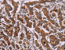 ID2 Antibody - Immunohistochemistry of paraffin-embedded Human liver cancer using ID2 Polyclonal Antibody at dilution of 1:30.