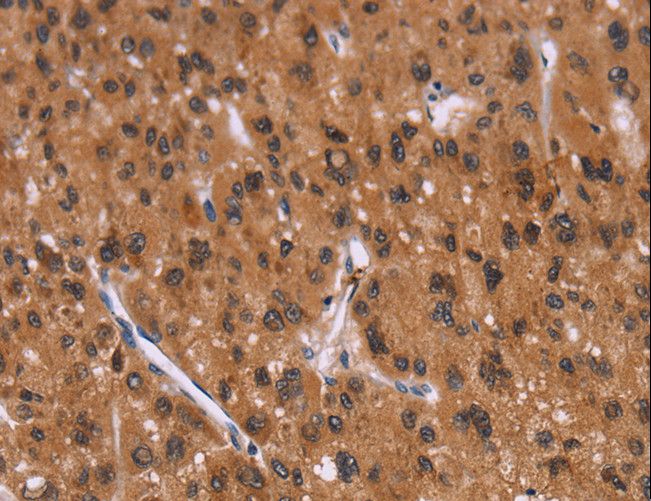 ID2 Antibody - Immunohistochemistry of paraffin-embedded Human liver cancer using ID2 Polyclonal Antibody at dilution of 1:30.