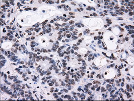 ID3 Antibody - IHC of paraffin-embedded Adenocarcinoma of colon tissue using anti-ID3 mouse monoclonal antibody. (Dilution 1:50).