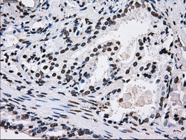 ID3 Antibody - IHC of paraffin-embedded Carcinoma of prostate tissue using anti-ID3 mouse monoclonal antibody. (Dilution 1:50).