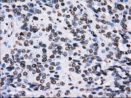 ID3 Antibody - IHC of paraffin-embedded Carcinoma of bladder tissue using anti-ID3 mouse monoclonal antibody. (Dilution 1:50).