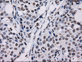 ID3 Antibody - IHC of paraffin-embedded Adenocarcinoma of breast tissue using anti-ID3 mouse monoclonal antibody. (Dilution 1:50).
