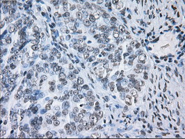 ID3 Antibody - IHC of paraffin-embedded Adenocarcinoma of ovary tissue using anti-ID3 mouse monoclonal antibody. (Dilution 1:50).
