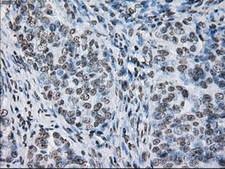 ID3 Antibody - IHC of paraffin-embedded Adenocarcinoma of ovary tissue using anti-ID3 mouse monoclonal antibody. (Dilution 1:50).
