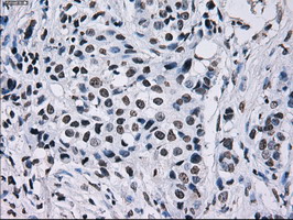 ID3 Antibody - IHC of paraffin-embedded Adenocarcinoma of breast tissue using anti-ID3 mouse monoclonal antibody. (Dilution 1:50).